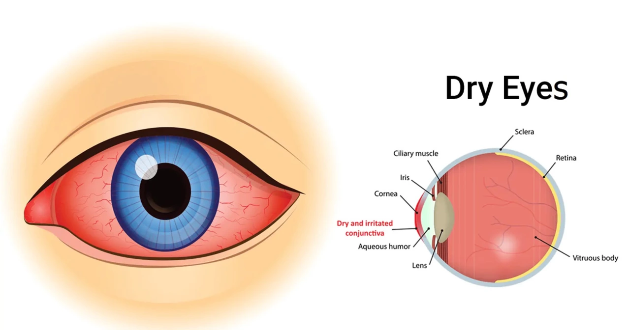 The Link Between Bacterial Eye Infections and Chronic Dry Eye