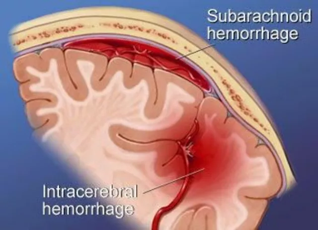 The Link between Subarachnoid Hemorrhage and Brain Injuries