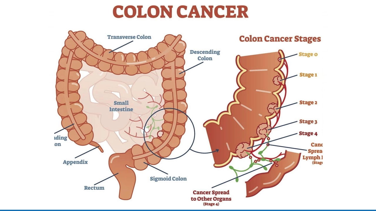 The Use of Everolimus in the Treatment of Colorectal Cancer